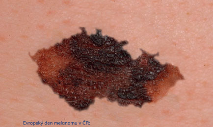 22. EVROPSKÝ DEN MELANOMU V ČESKÉ REPUBLICE 2. – 31. 5. 2022